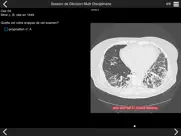 fibrose pulmonaire 2017 ipad images 2