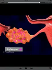 gynaecology - understanding disease ipad images 4