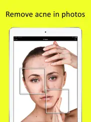 zit zapper - remove pimples ipad images 1