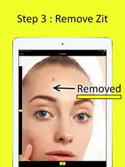 zit zapper - remove pimples ipad images 4